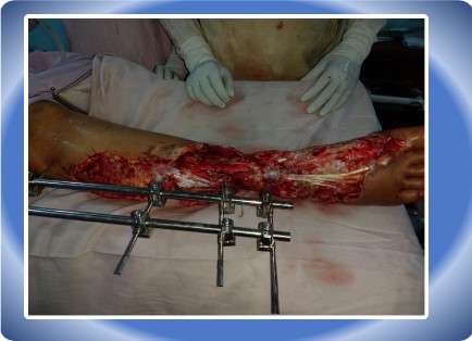 LOWER LIMB INJURY